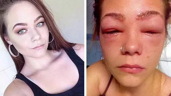 Allergic to dye