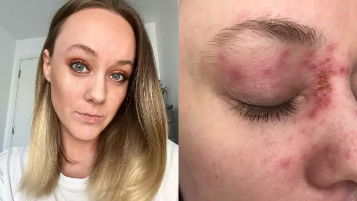 Eczema 