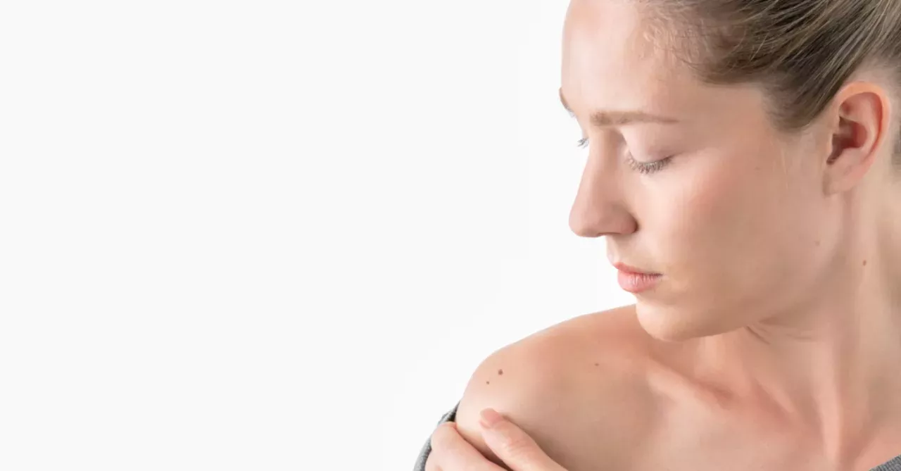 melanoma
