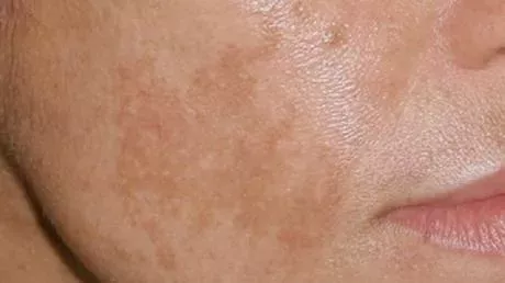 4 habits that cause dark spots on skin.