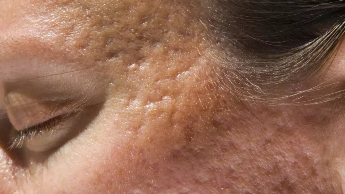 Atrophic Scarring: What It Is and How To Treat It