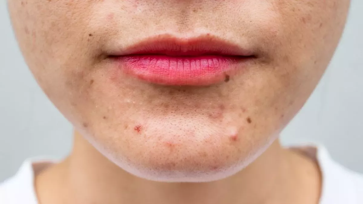 Cystic Acne: What It Is And How To Treat It