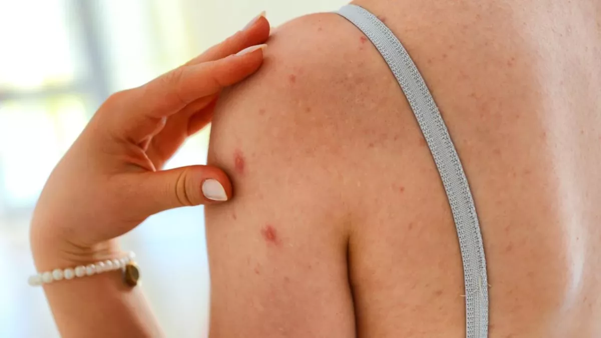 How To Conquer Body Acne