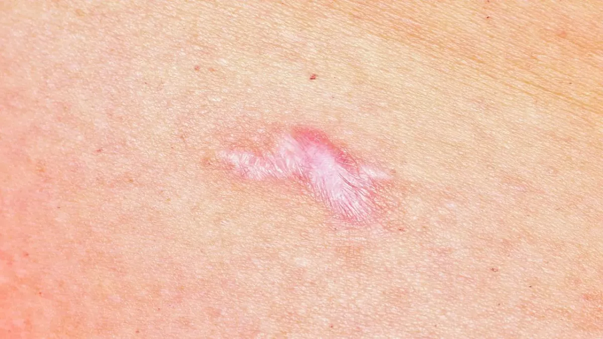 Hypertrophic Scars Explained: Why They Occur and How To Treat Them