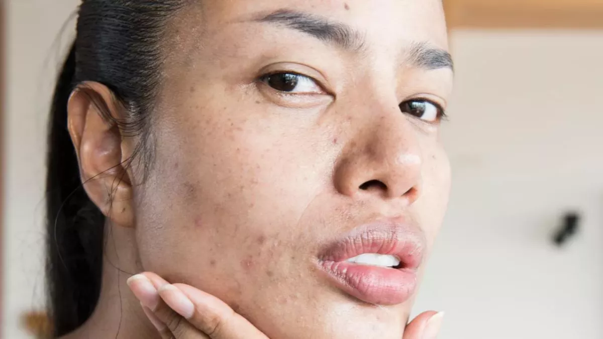 These products will prevent acne scarring from happening to you 