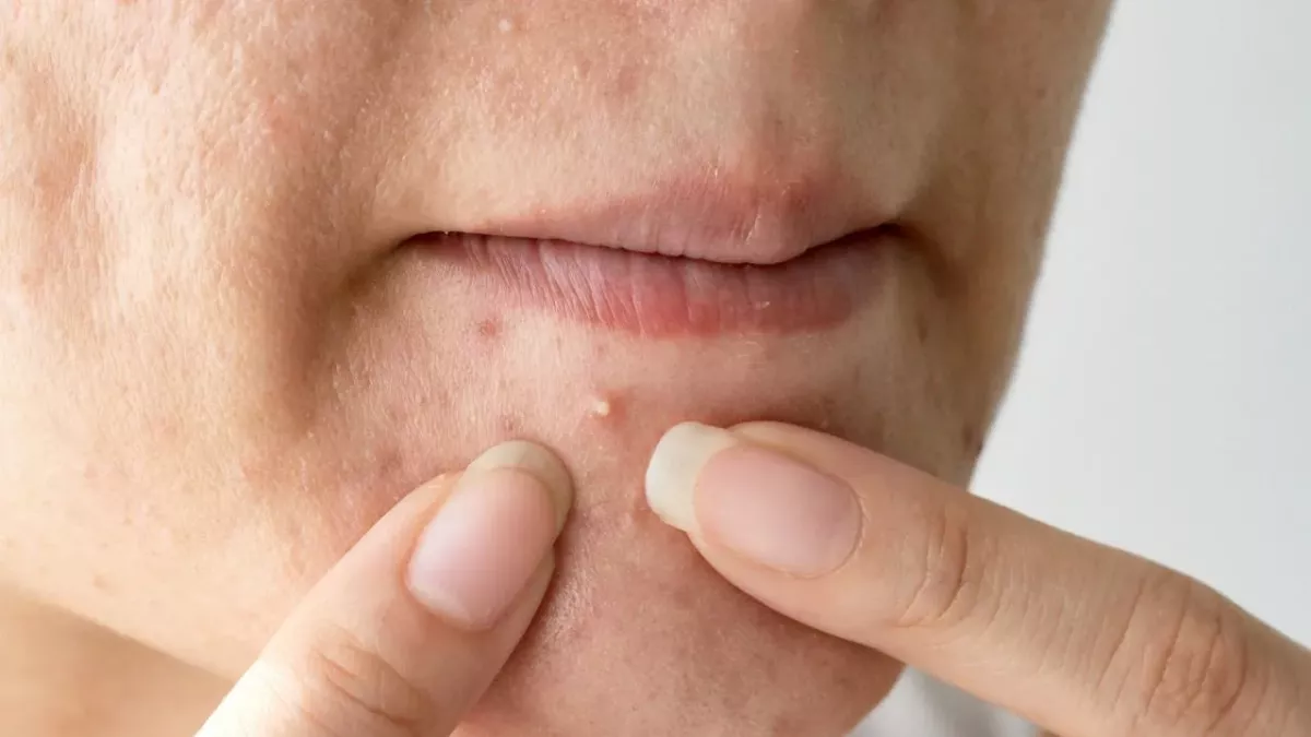 Understanding the Six Types of Acne and How To Treat Them
