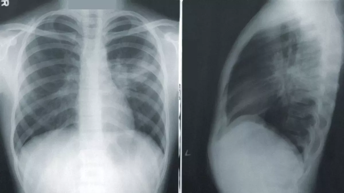COVID x rays