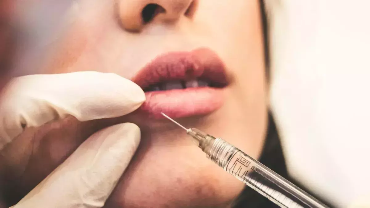 Herpes: Lip fillers can increase your chances of getting cold sores