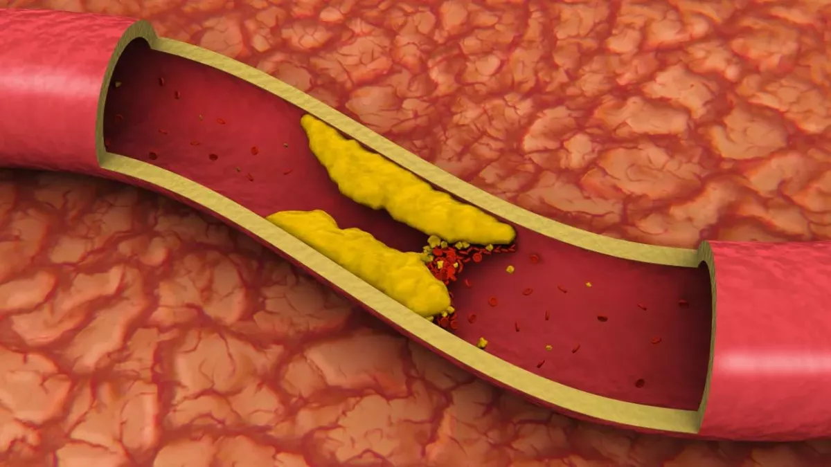 What is venous thrombosis, and do COVID vaccines cause it?