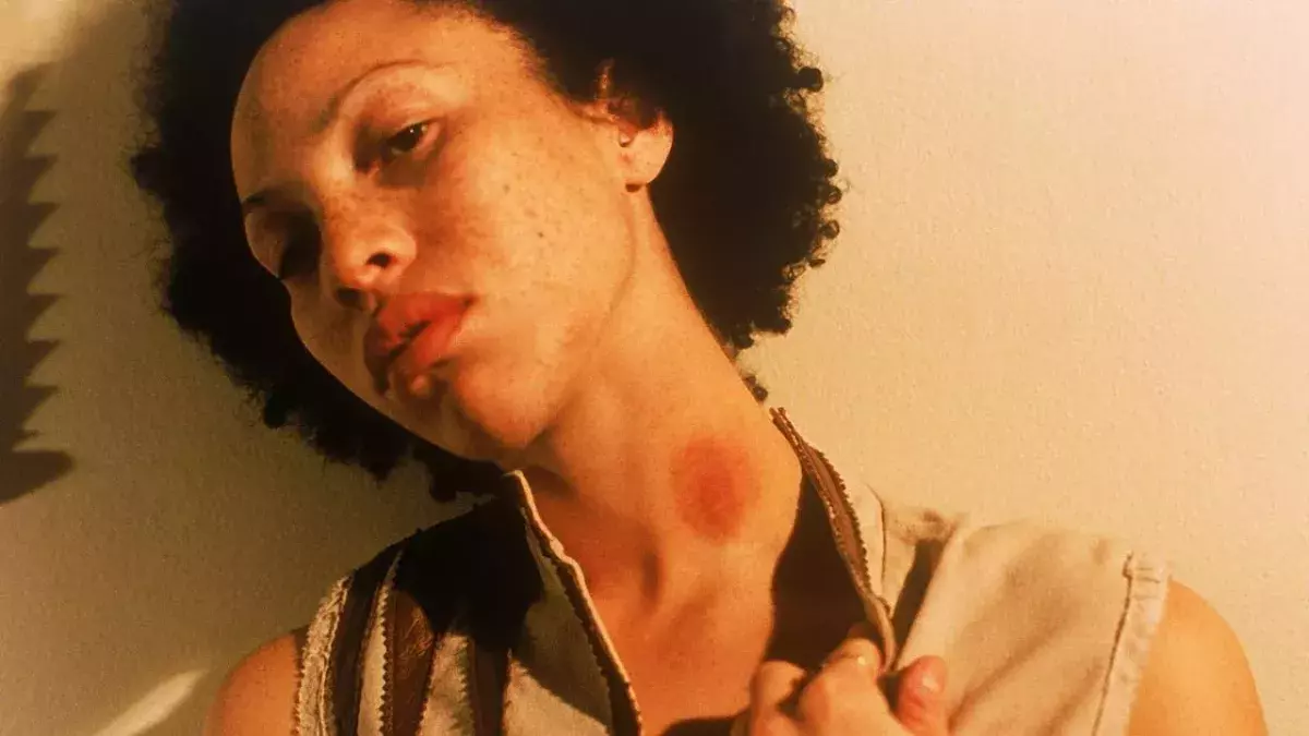 How to get rid of Hickeys quickly?