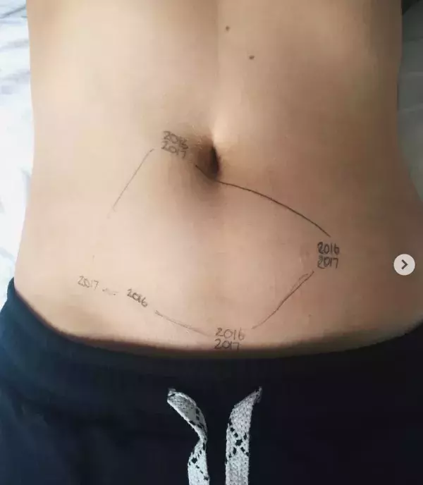 Anonymous photo sharing the marks of endometriosis on instagram thanks to the hashtag ‘this is endometriosis’