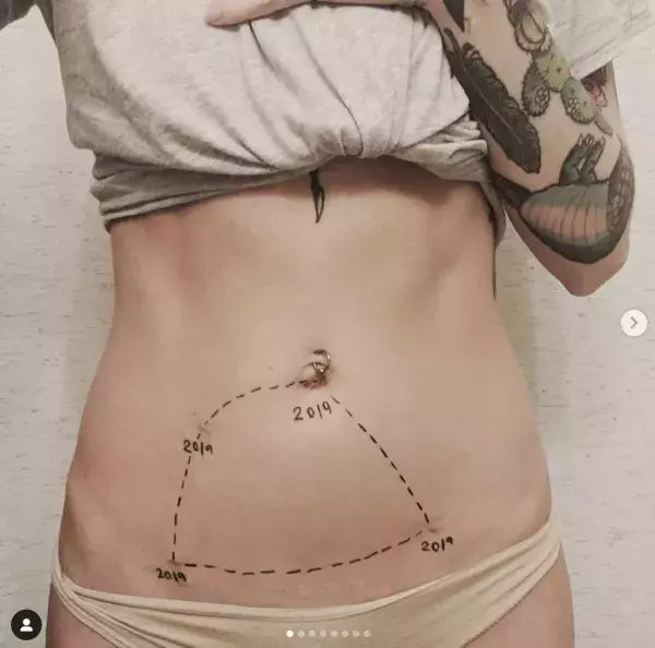 Anonymous photo sharing the marks of endometriosis on instagram thanks to the hashtag ‘this is endometriosis’