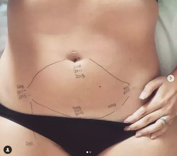 Anonymous photo sharing the marks of endometriosis on instagram thanks to the hashtag ‘this is endometriosis’