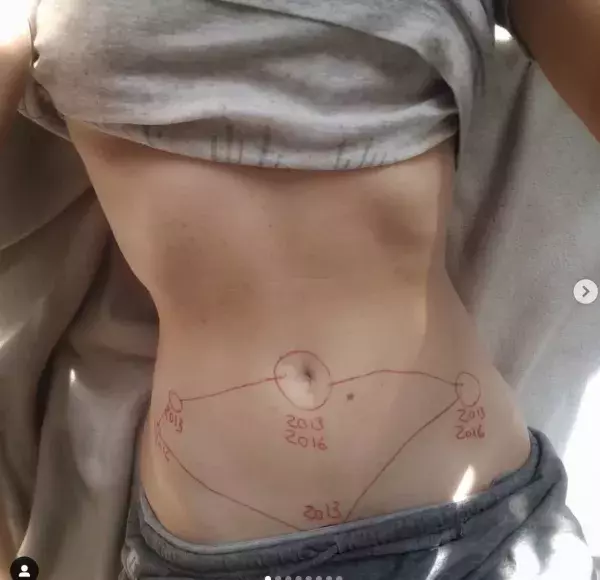 Anonymous photo sharing the marks of endometriosis on instagram thanks to the hashtag ‘this is endometriosis’