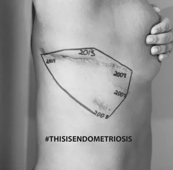 Anonymous photo sharing the marks of endometriosis on instagram thanks to the hashtag ‘this is endometriosis’